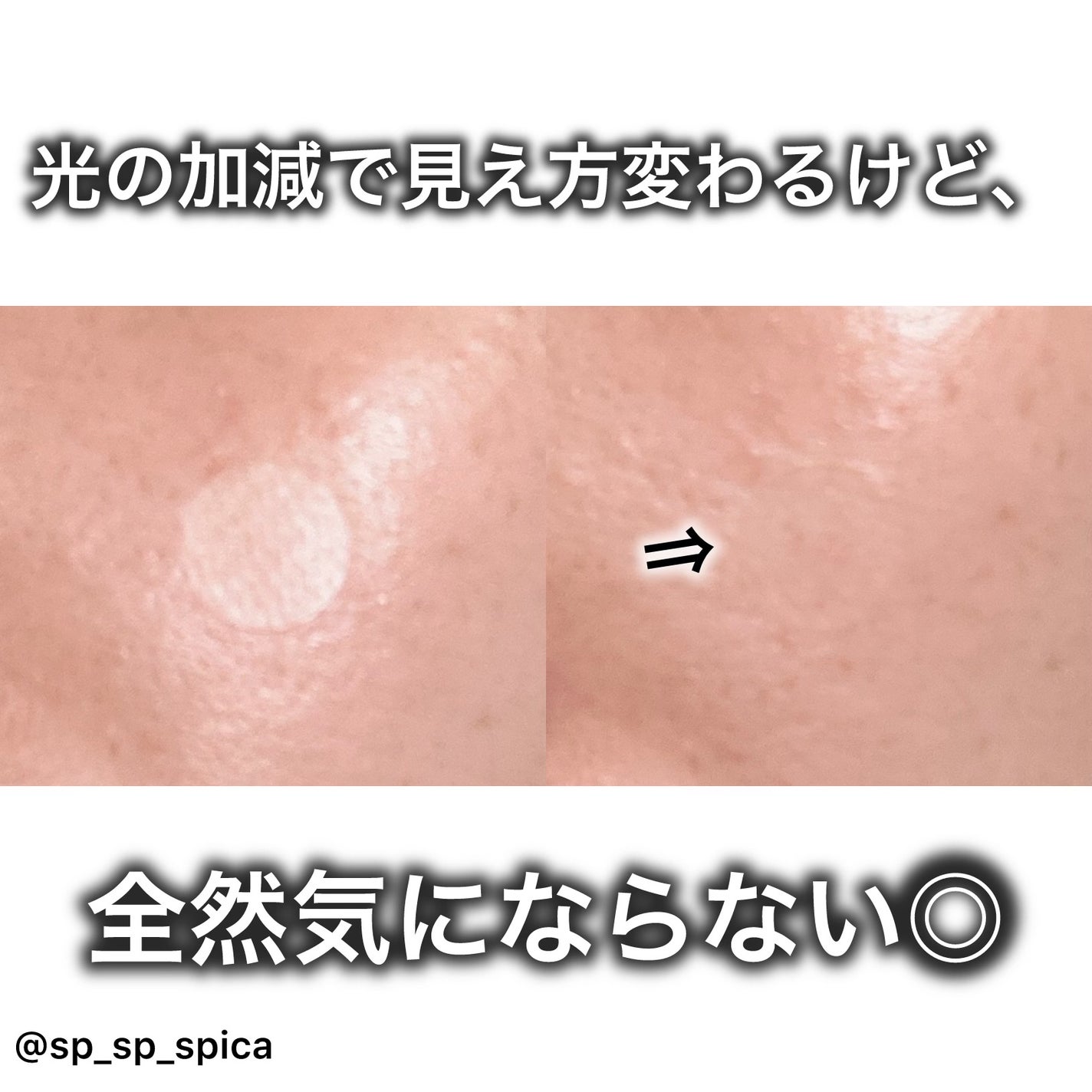 SPOT PATCH ロールタイプ/Shupong/にきびパッチを使ったクチコミ(3枚目)