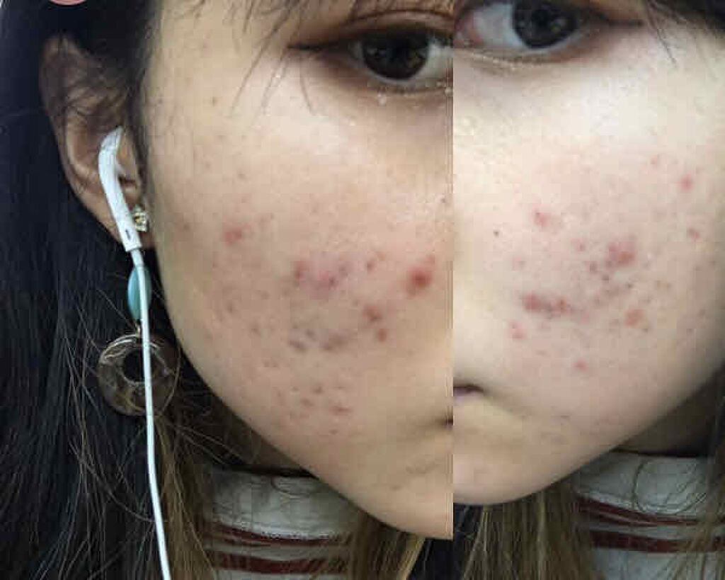 オードムーゲ 薬用ローション（ふきとり化粧水）/オードムーゲ/拭き取り化粧水を使ったクチコミ（1枚目）