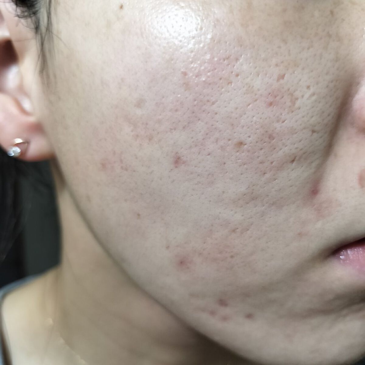 Azelaic Acid Suspension 10%/The Ordinary/美容液を使ったクチコミ（1枚目）