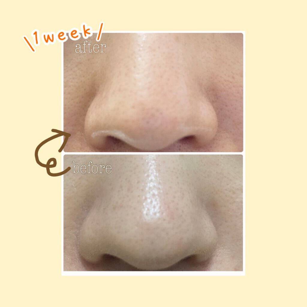 スーパー毛穴ピールセラム/ラボラボ/美容液を使ったクチコミ(3枚目)