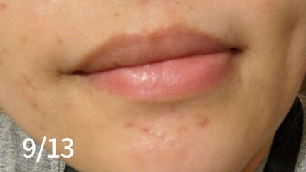 チョコラBBプラス (医薬品)/チョコラBB/その他を使ったクチコミ(6枚目)