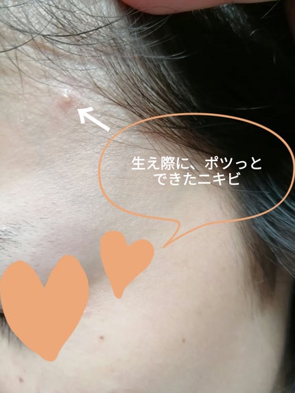 ゼロスポットパッチ/Today’s Cosme/にきびパッチを使ったクチコミ(2枚目)