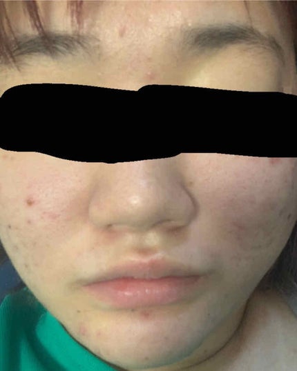 にきびちゃん゛ on LIPS 「今日から毎日あげて行けたらいいなって思ってます!私は中2ぐらい..」(2枚目)