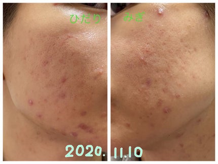 せんな on LIPS 「12年共にしたニキビ肌からさよなら!美肌目指して頑張っています..」(1枚目)