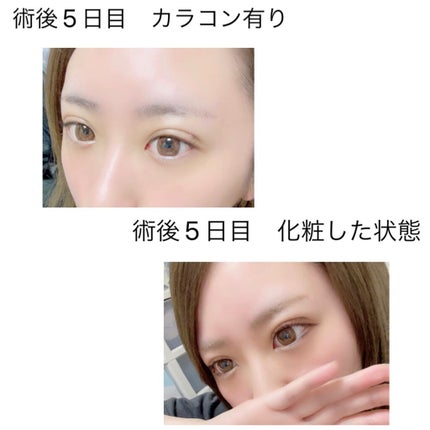 あんにんどーふ。 on LIPS 「🔥🤍🔥🤍🔥🤍🔥🤍🔥🤍私事ですが、【二重埋没法】をしてきたので記..」(5枚目)