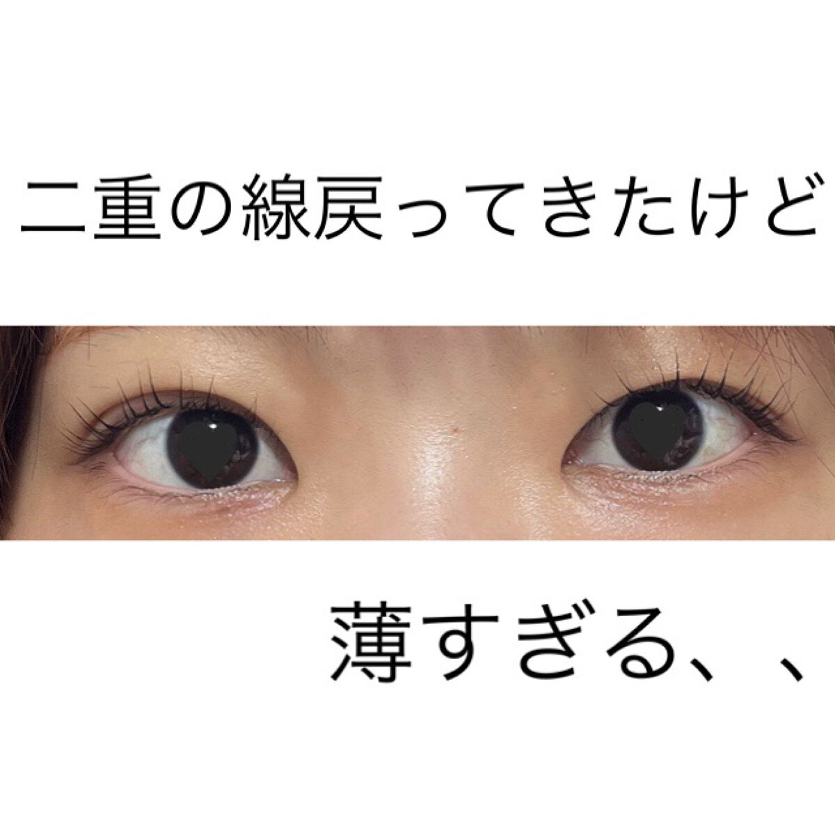 二重整形/その他を使ったクチコミ（1枚目）