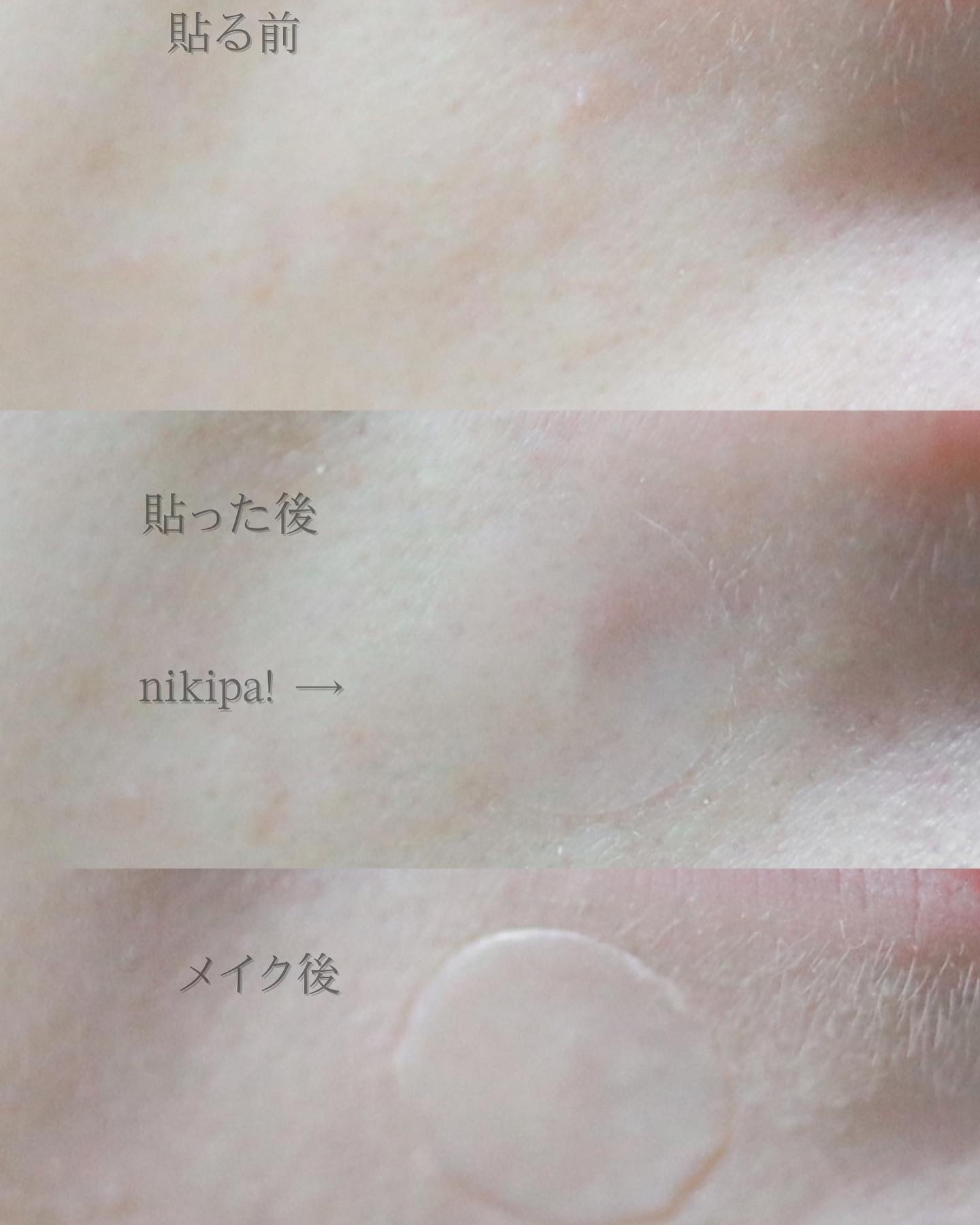 極薄透明パッチ nikipa!/金冠堂/にきびパッチを使ったクチコミ（2枚目）