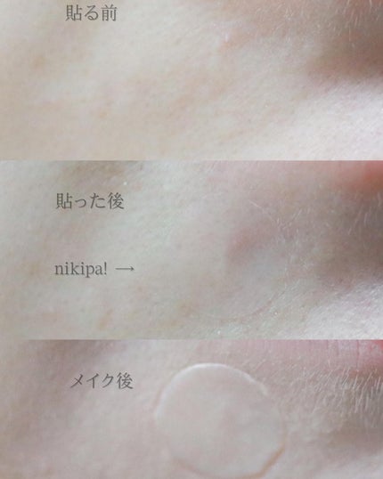 極薄透明パッチ nikipa!/金冠堂/にきびパッチを使ったクチコミ(2枚目)