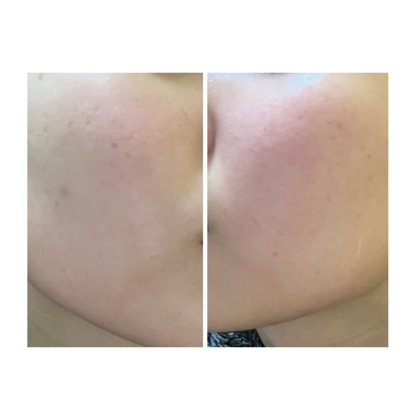 ぽむ on LIPS 「2023.9.13皮膚科に受診 エピデュオとヘパリン処方1枚目..」(1枚目)