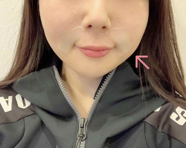 メディリフト 3Dマイクロフィラー(口元用)/YA-MAN TOKYO JAPAN/シートマスク・パック by ねこ💄フォロバ100