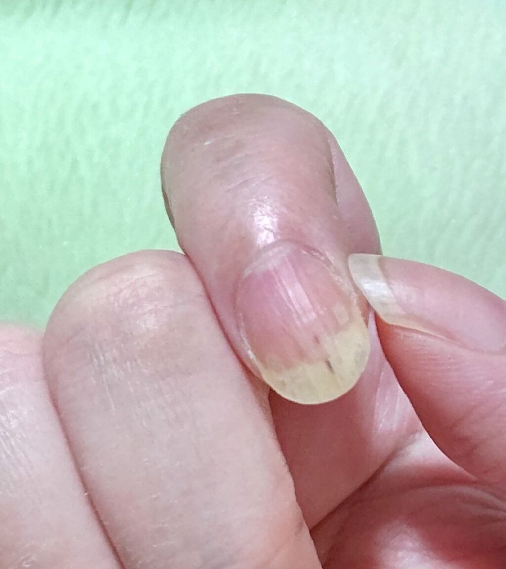 薬用ハンドクリーム Dhcを使った口コミ 怪我による右手人差し指の爪甲剥離症 その By らいな リムるならフォローしないで 怒 敏感肌 Lips