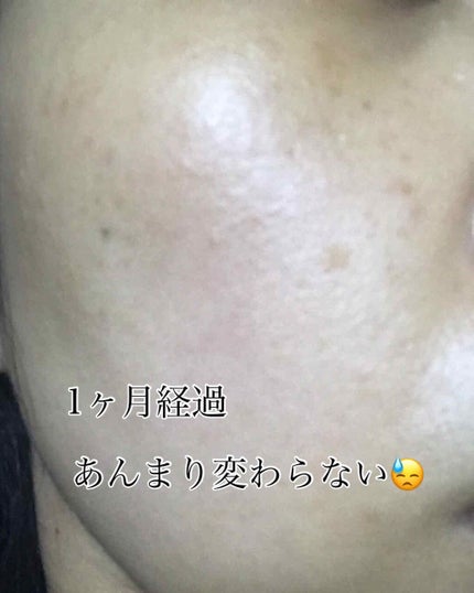 薬用 しみ 集中対策 美容液/メラノCC/美容液を使ったクチコミ(3枚目)