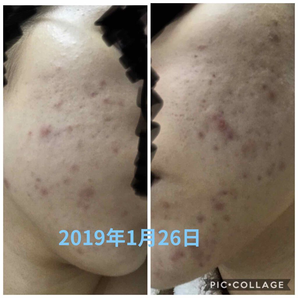 クラリファイング ローション 3/CLINIQUE/拭き取り化粧水を使ったクチコミ（2枚目）