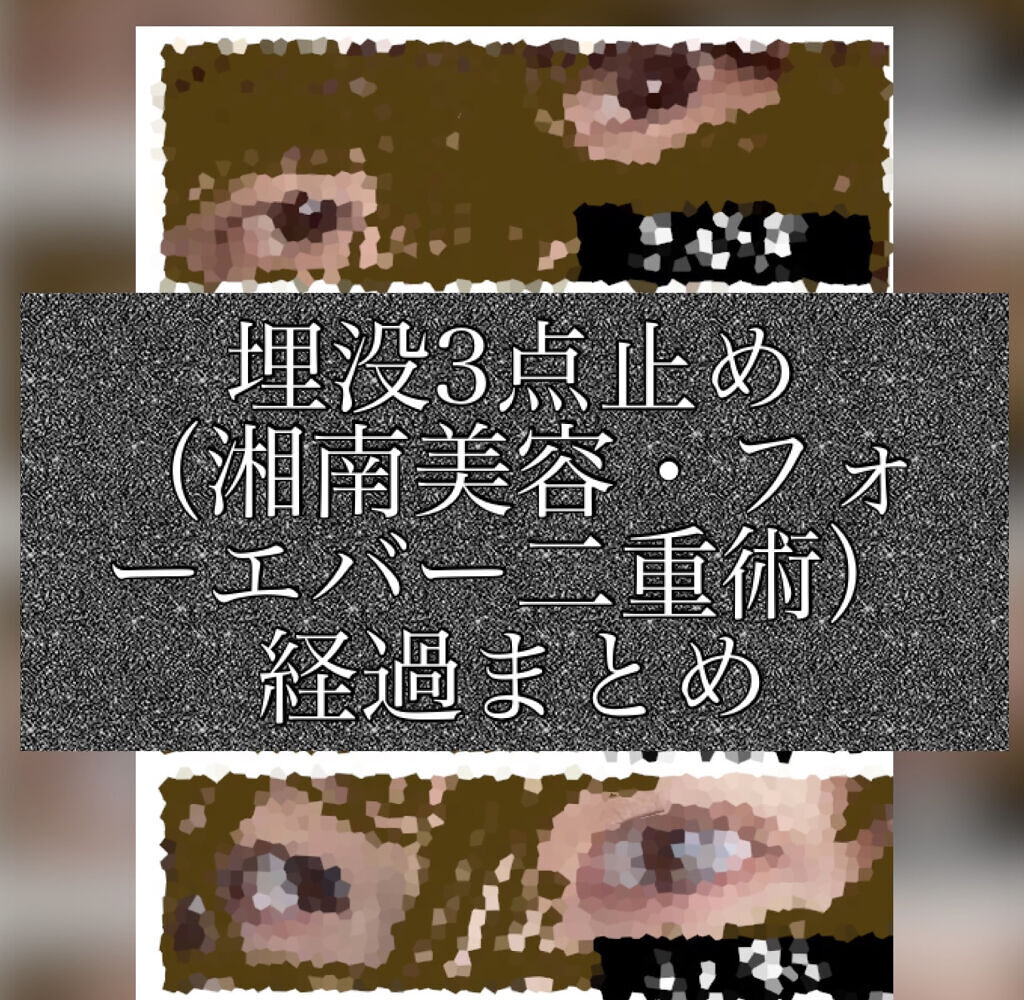 二重整形/その他を使ったクチコミ（1枚目）