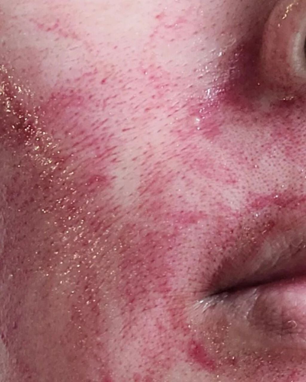 AHA 30% + BHA 2% Peeling Solution/The Ordinary/ピーリングを使ったクチコミ(7枚目)