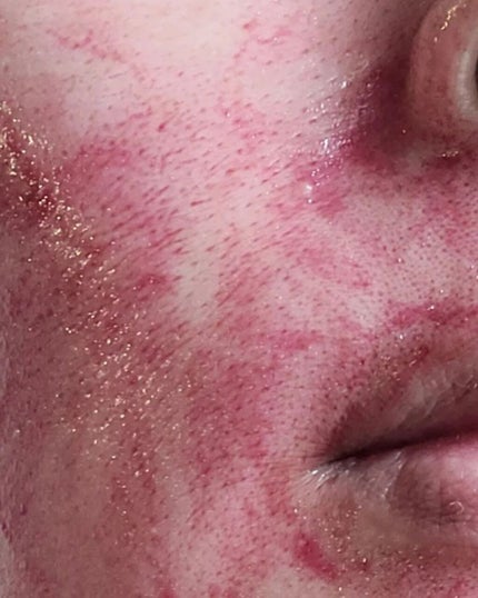 AHA 30% + BHA 2% Peeling Solution/The Ordinary/ピーリングを使ったクチコミ(7枚目)