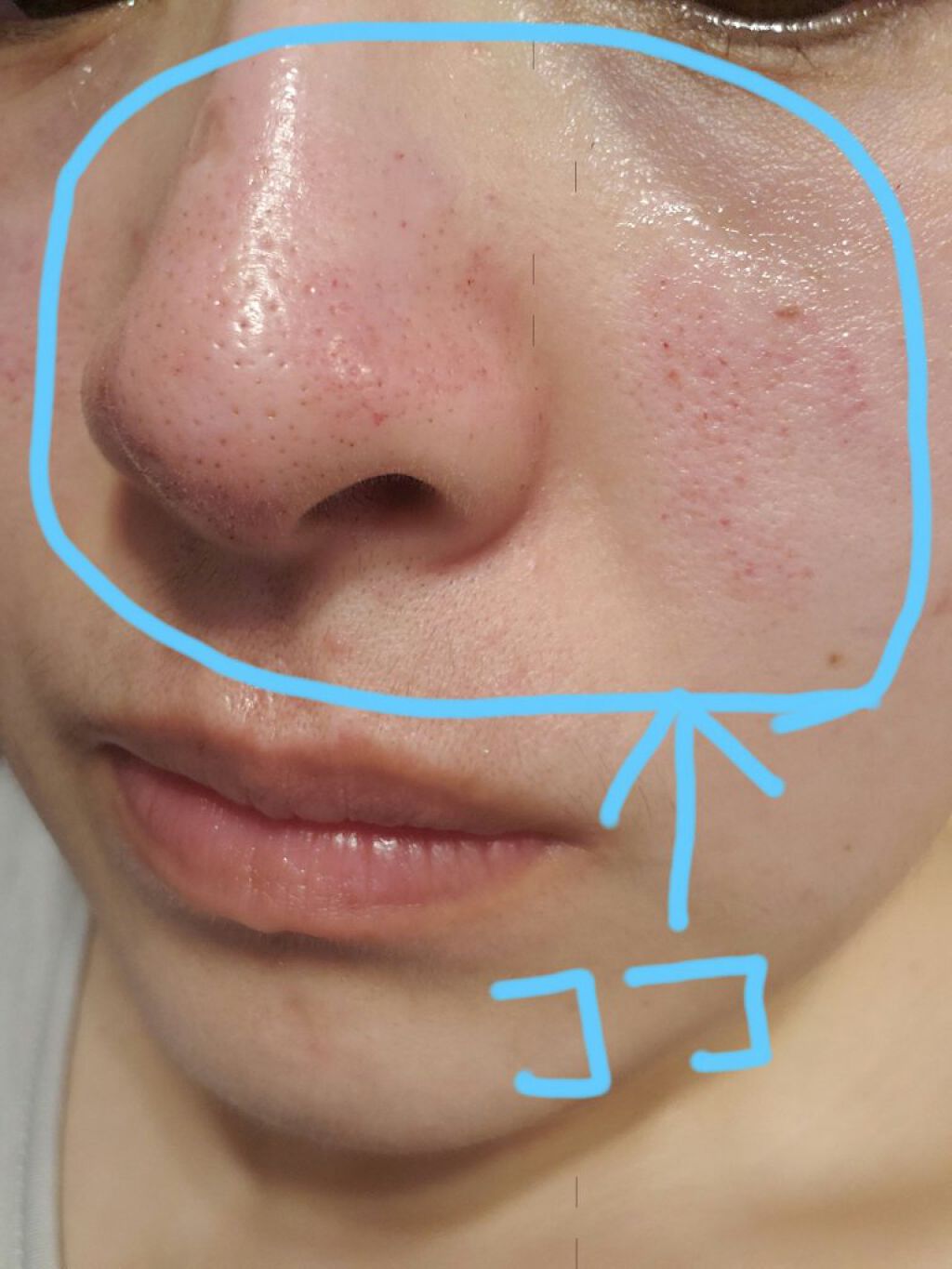 ダーマペン・ダーマスタンプ/MyM/その他スキンケアグッズを使ったクチコミ(6枚目)