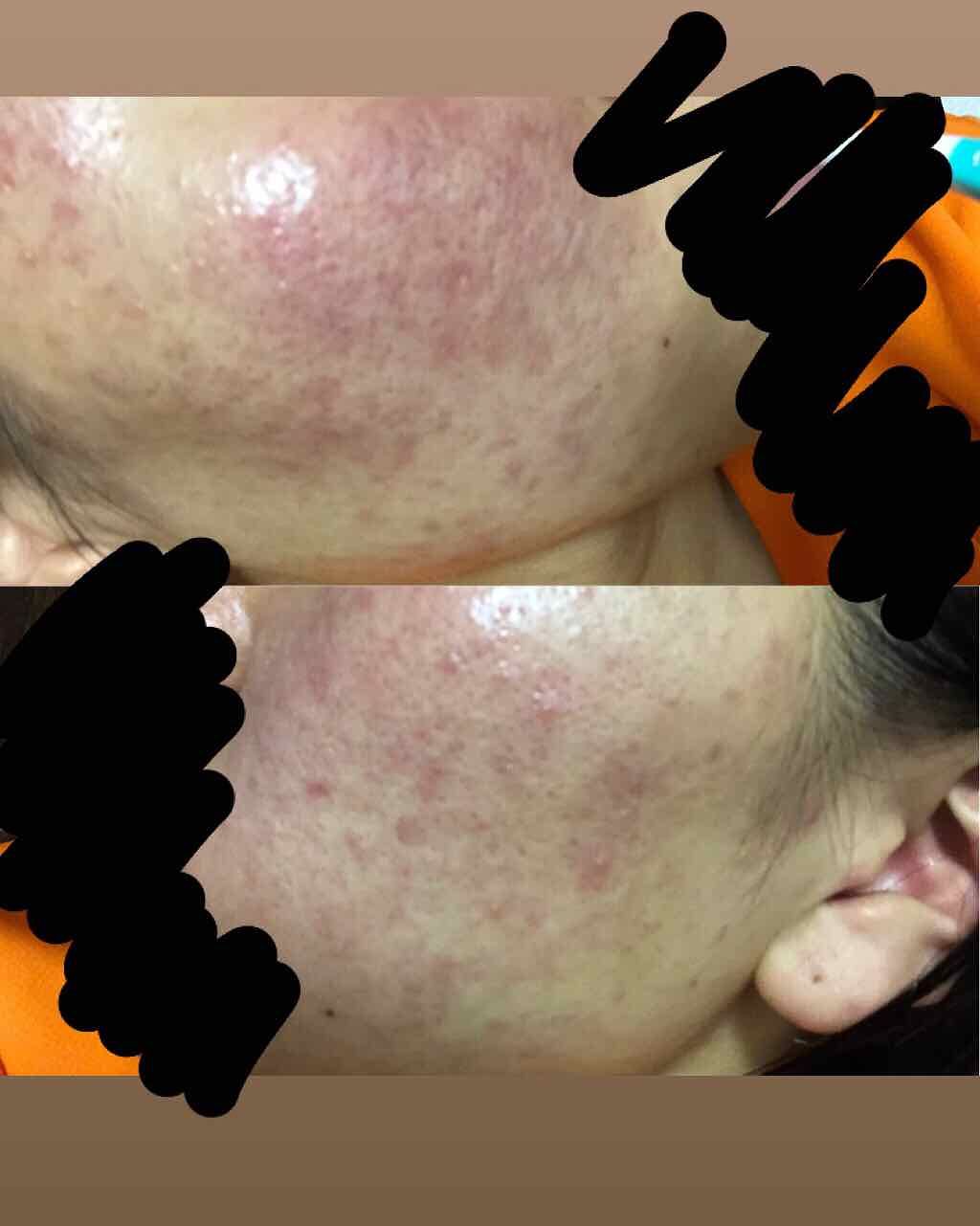 orange_lips_sr9 on LIPS 「小4からプツプツとではじめたニキビ。プロアクティブも効果はなく..」(2枚目)
