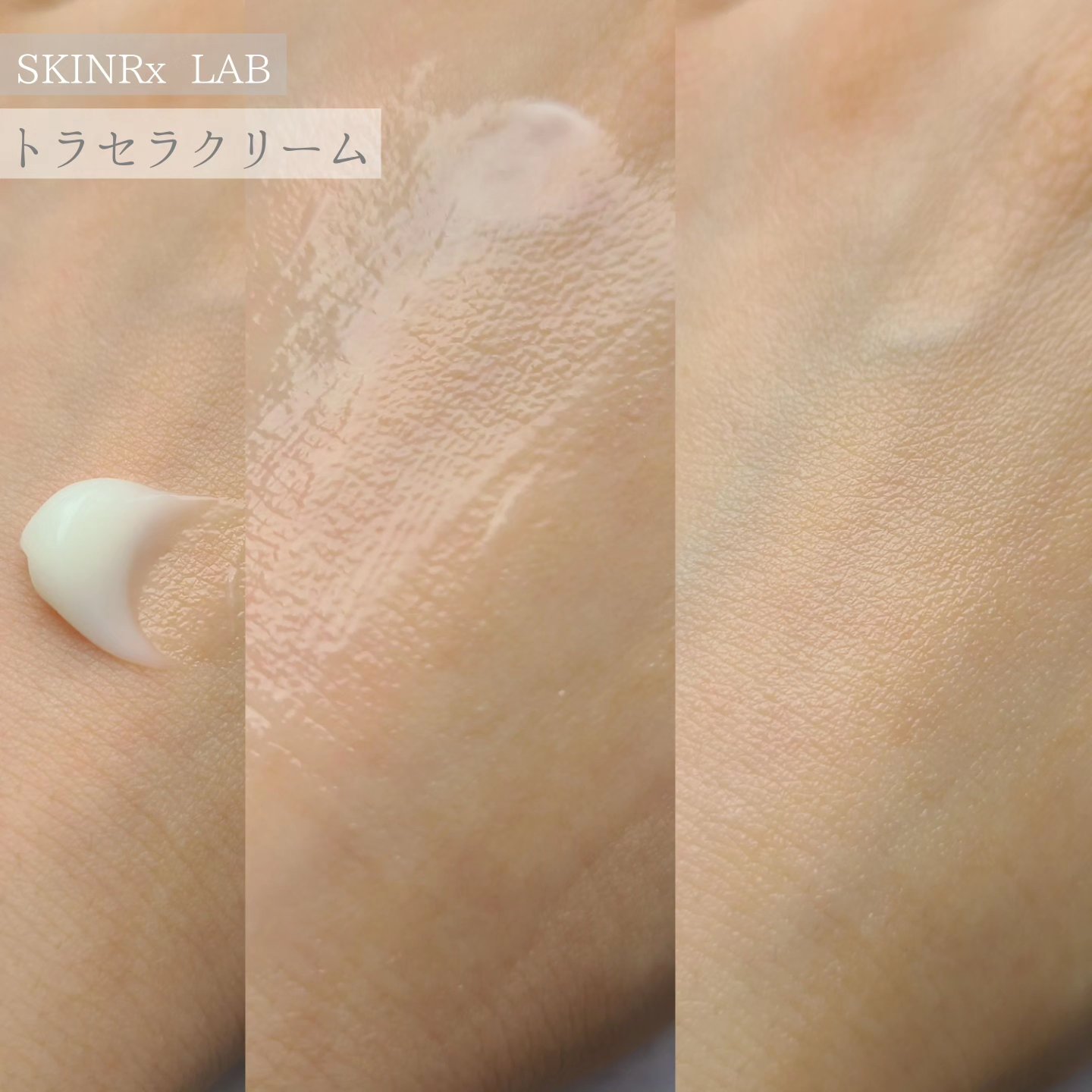 トラセラクリーム 50ml/SKINRx LAB/フェイスクリームを使ったクチコミ（3枚目）