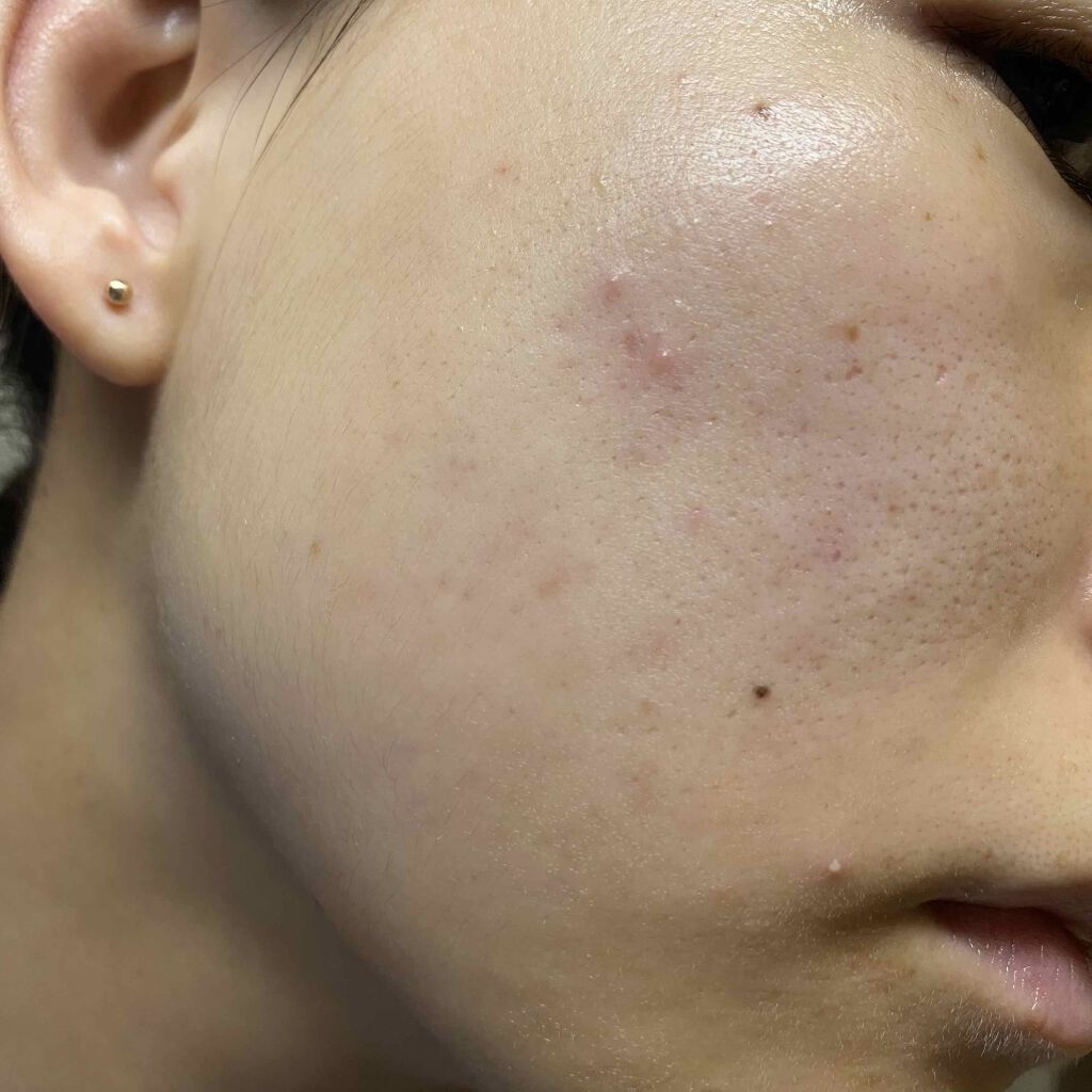 fresh_lips_rmq on LIPS 「5/7さぼりまくってたオバジのおかげで毛穴マシになった?..」(1枚目)