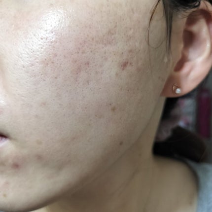 ティーツリーカーミングハイドロジェル/MEDIHEAL/ボディローションを使ったクチコミ(1枚目)