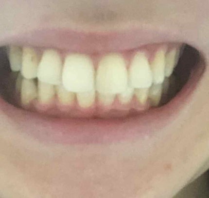 ミュゼホワイトニング 速攻美白 ポリリンキューブ 3個入り/ミュゼホワイトニング/歯磨き粉を使ったクチコミ(2枚目)