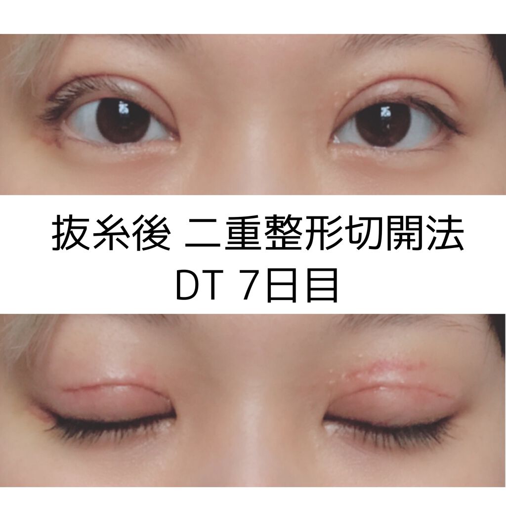 りんたろう on LIPS 「こんにちは☺️本日抜糸して来ました。二重整形の切開でいちばん痛..」(1枚目)