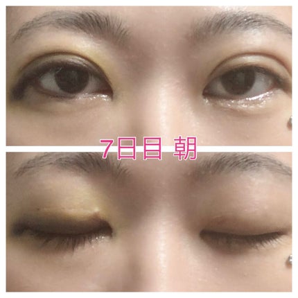 みぃ♔相互フォロー100% on LIPS 「※目の写真注意おはようございます🐣早くも7日が経過しました…4..」(4枚目)