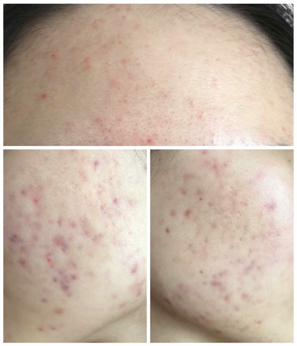 エピデュオゲル/マルホ株式会社/その他を使ったクチコミ（2枚目）