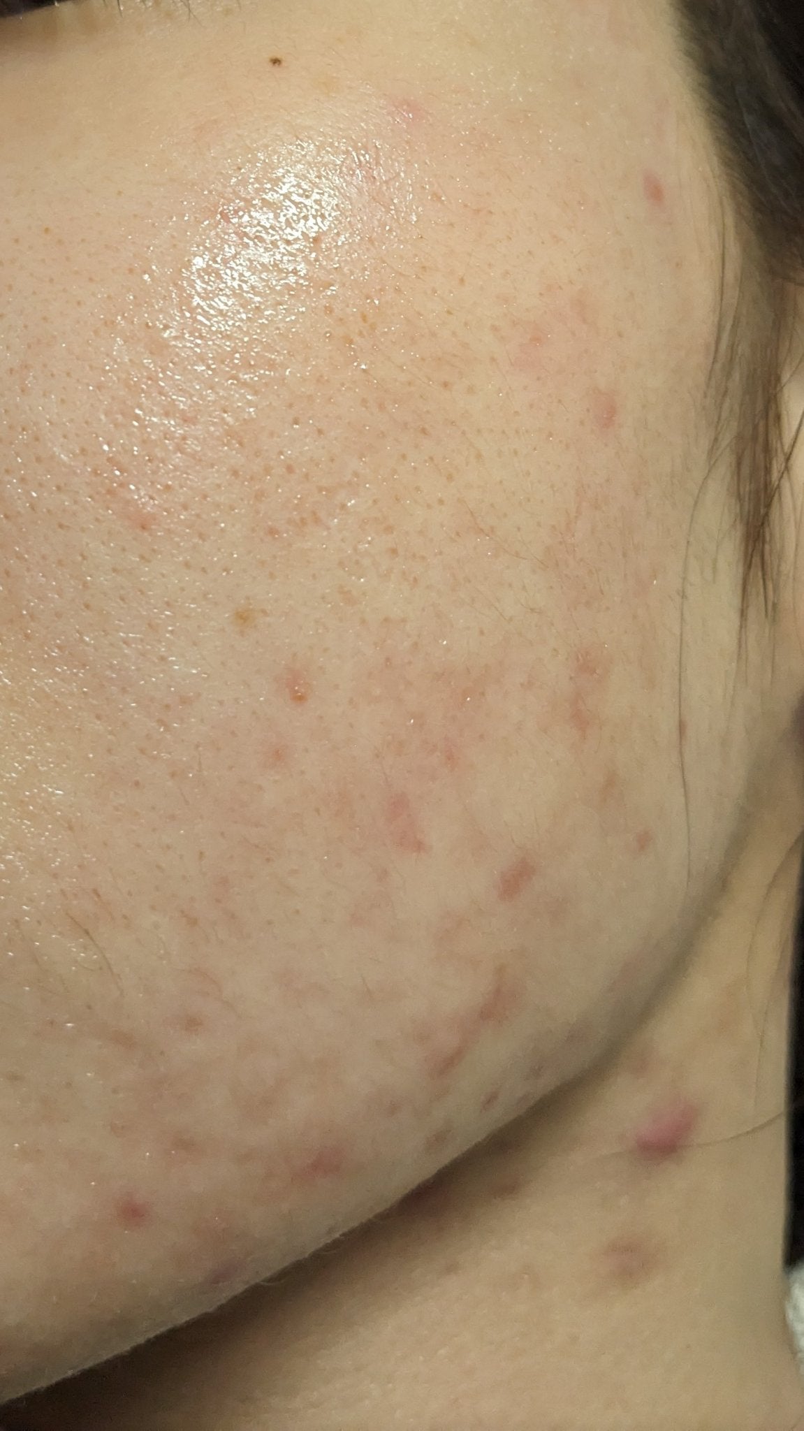 そこのお姉さん、美肌コスメ教えてくれよォ on LIPS 「2枚め激汚肌、3枚め最近の汚肌。どちらもnofilterでお送..」(2枚目)