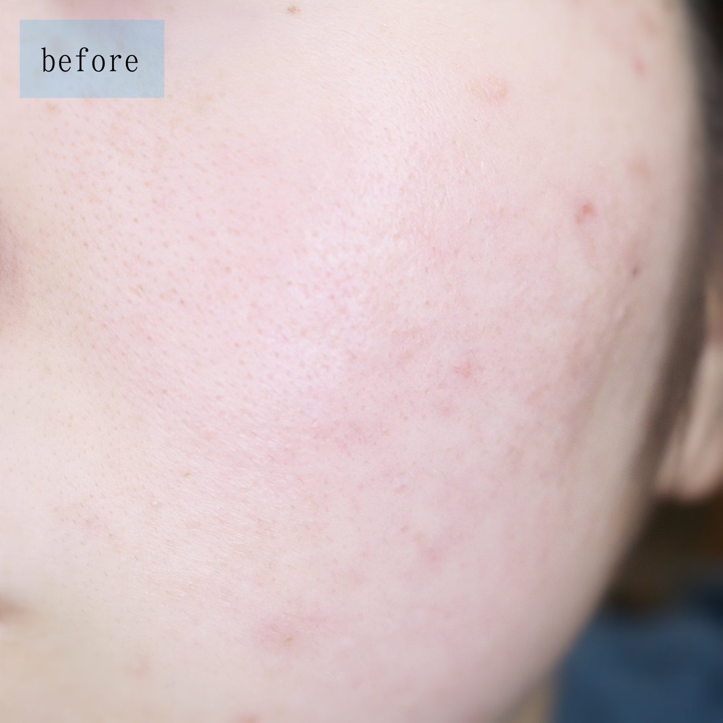 ピンクティーツリーカバークッション/APLIN/クッションファンデーションを使ったクチコミ(5枚目)