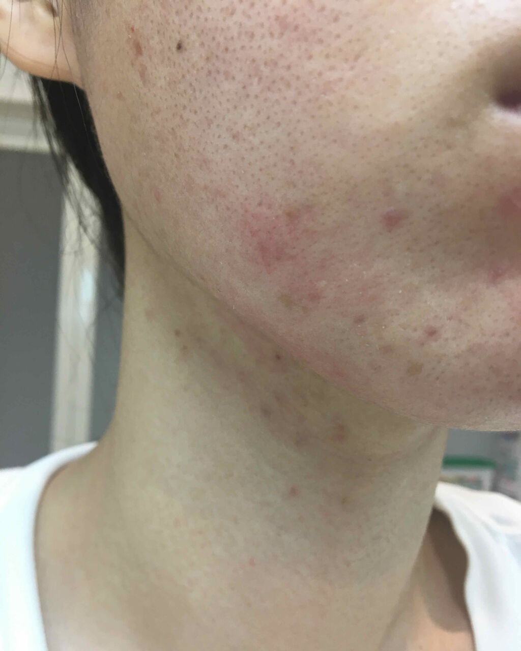 クロマイ-P軟膏AS(医薬品)/クロマイ/その他を使ったクチコミ（3枚目）