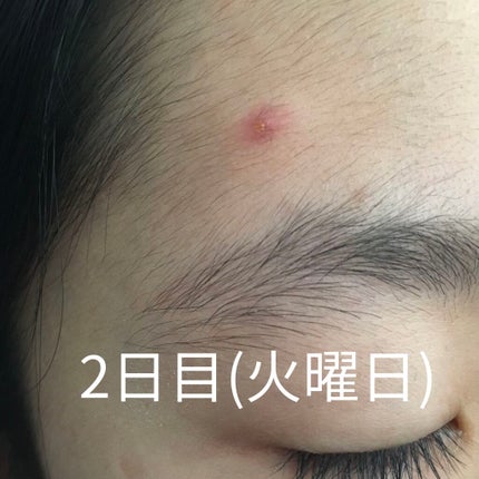 ペアアクネクリームW(医薬品)/ペア/その他を使ったクチコミ(4枚目)