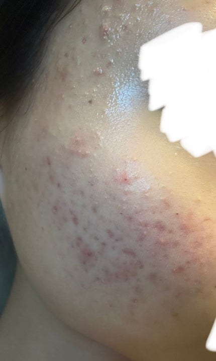 薬用しみ集中対策 プレミアム美容液/メラノCC/美容液を使ったクチコミ(1枚目)