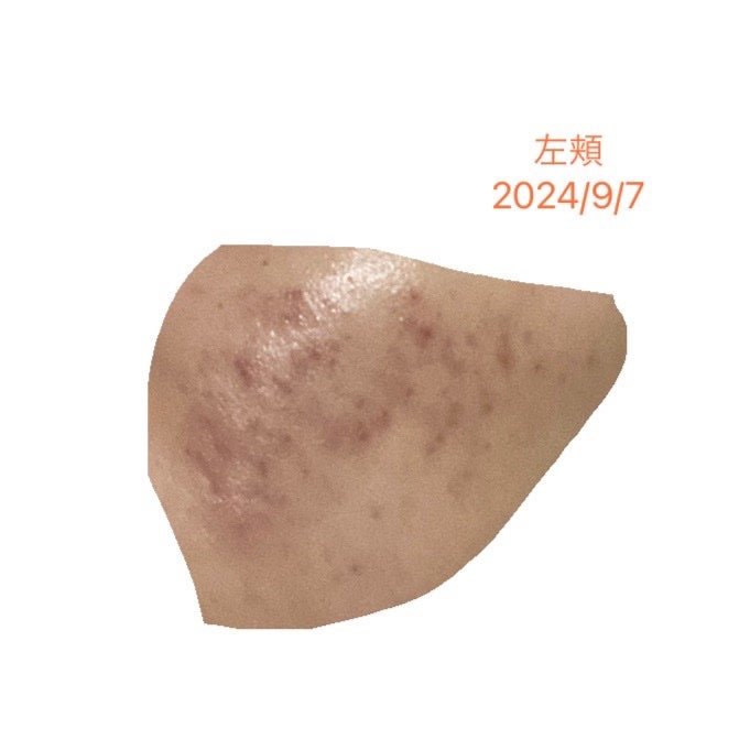 ぽよこ on LIPS 「2024/9/7ニキビの数は、先月よりは減りました。ニキビ跡は..」(2枚目)