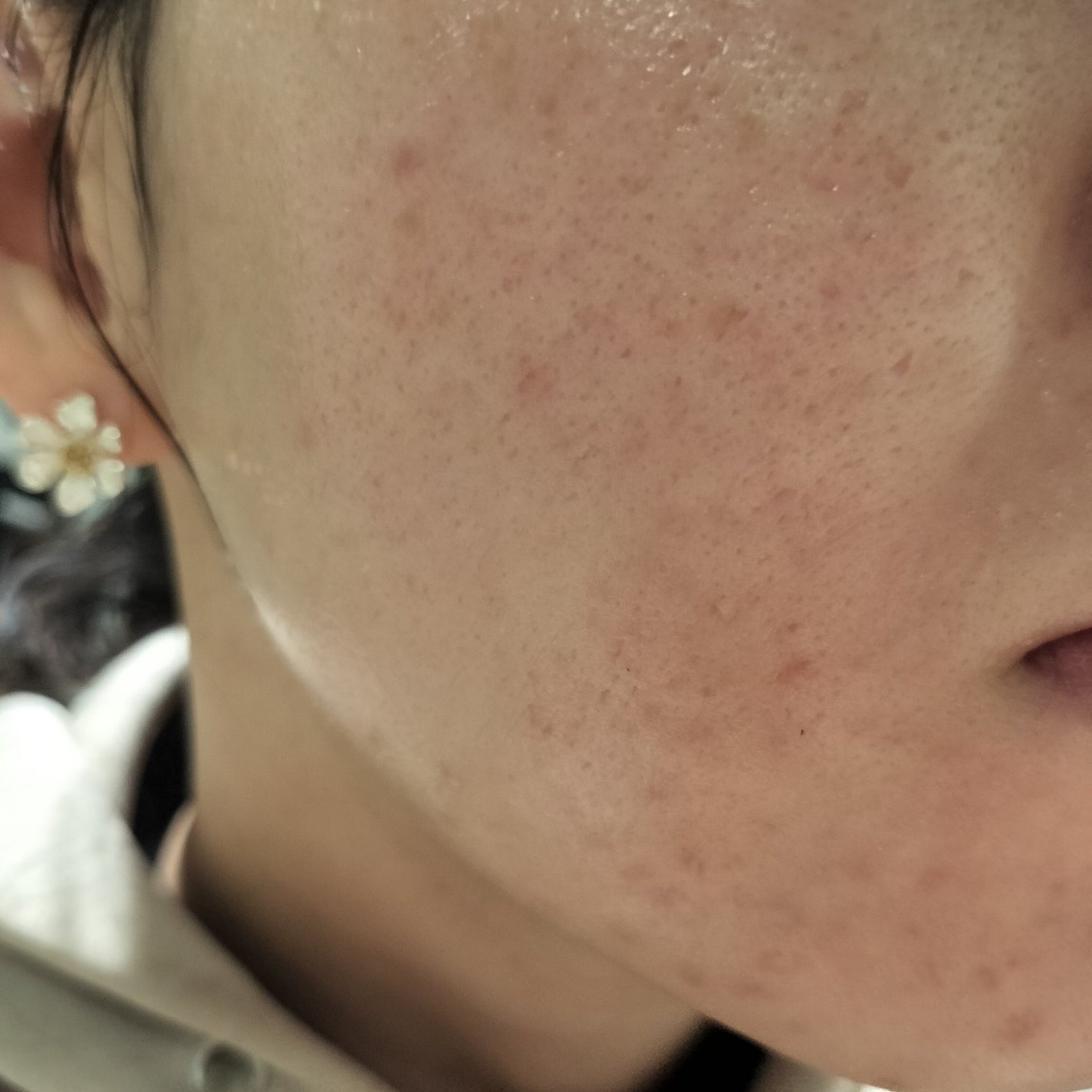 バイオイル/バイオイル/フェイスオイルを使ったクチコミ(1枚目)