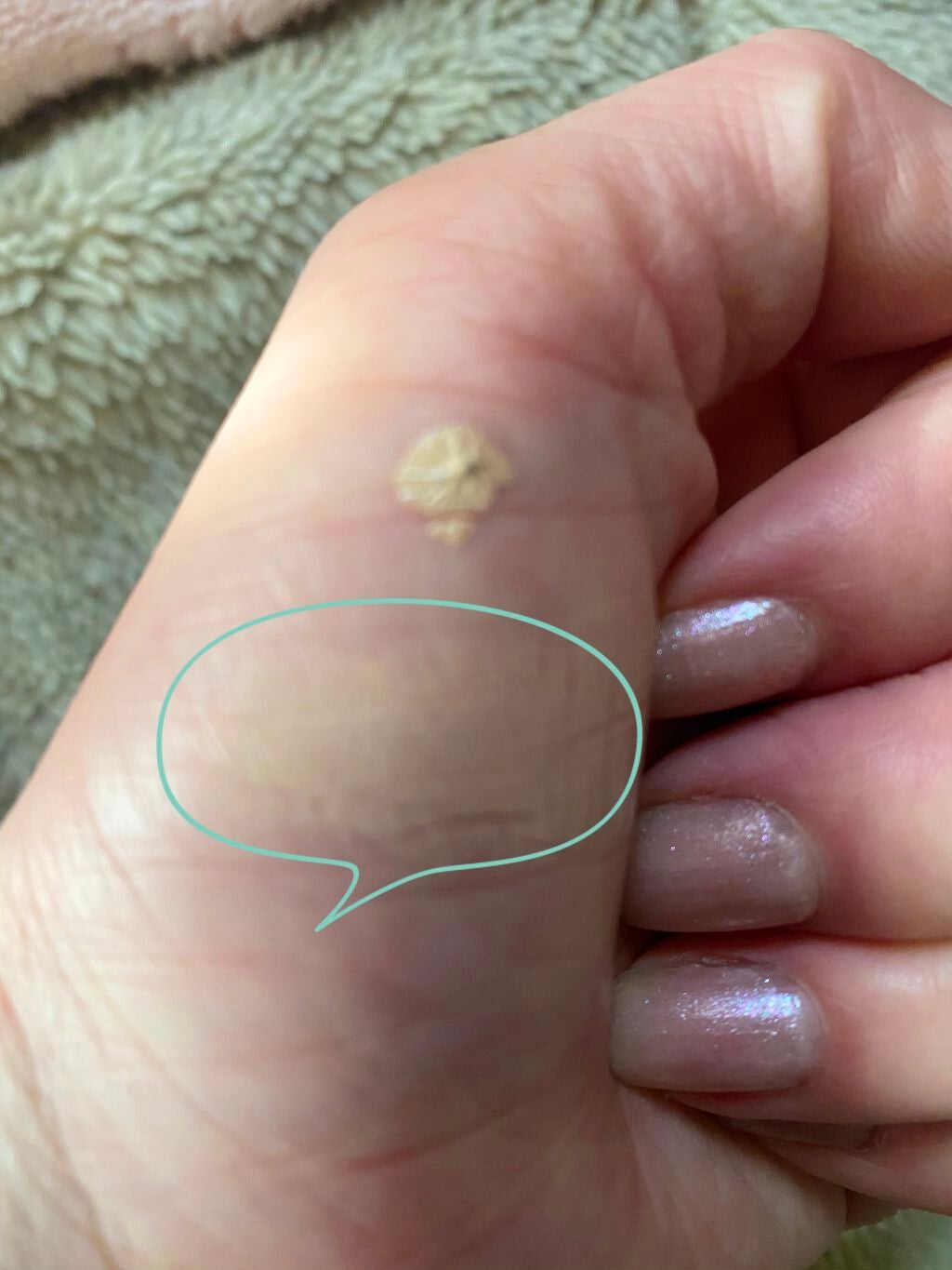 【旧】ディオールスキン フォーエヴァー スキン コレクト コンシーラー/Dior/リキッドコンシーラーを使ったクチコミ(3枚目)