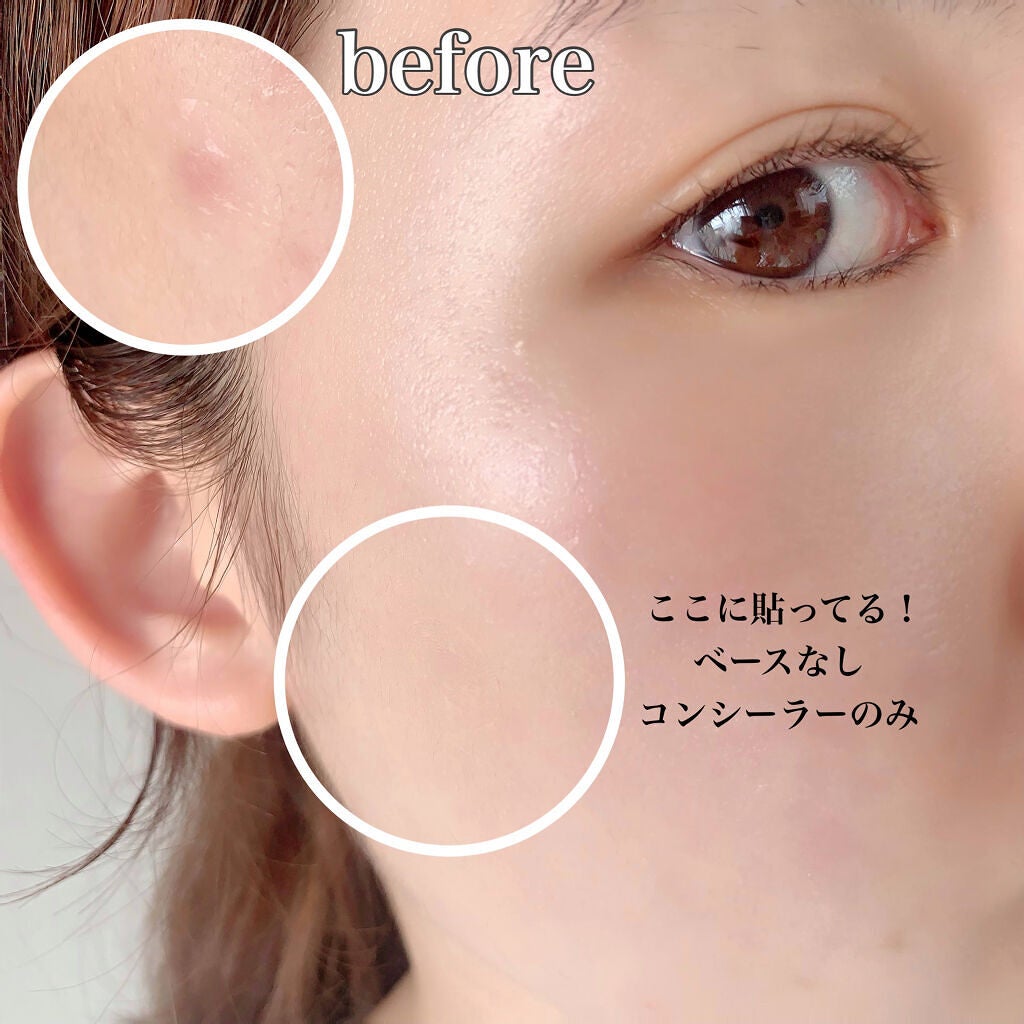 極薄透明パッチ nikipa!/金冠堂/にきびパッチを使ったクチコミ(3枚目)