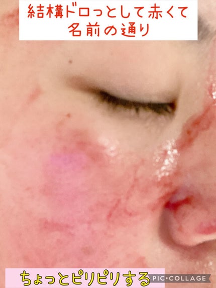 AHA 30% + BHA 2% Peeling Solution/The Ordinary/ピーリングを使ったクチコミ(3枚目)