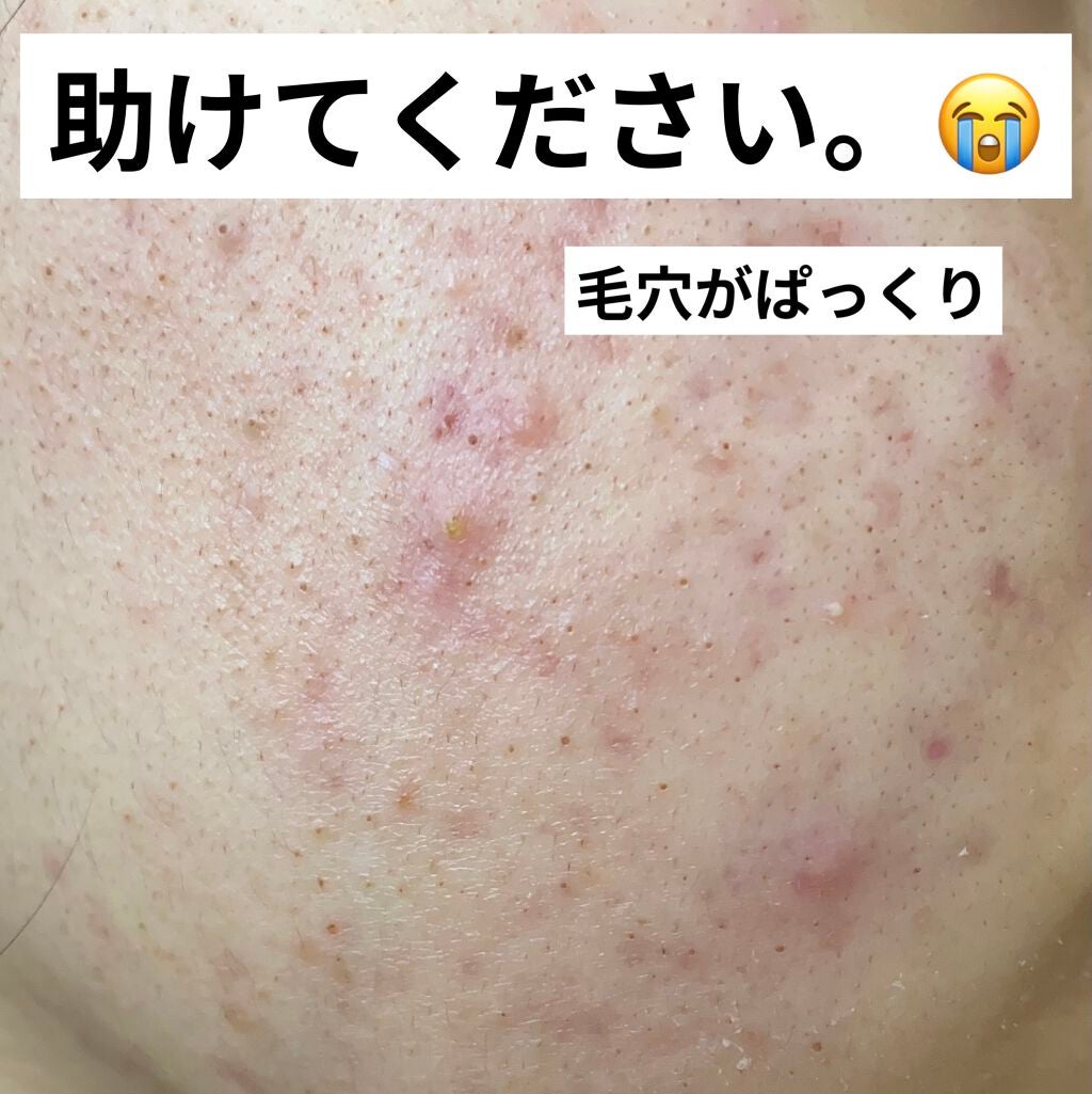らんらん on LIPS 「ニキビケアは頑張ってるものの最近毛穴が目立つように感じます(;..」(1枚目)