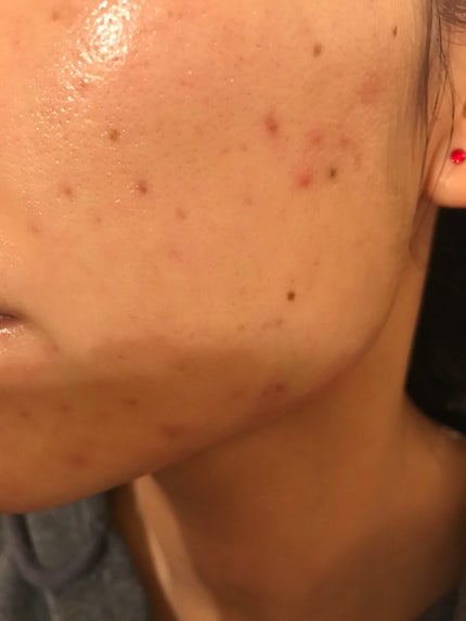 レチノールA 1% アドバンスドリバイタリゼーションクリーム/Life-flo/フェイスクリームを使ったクチコミ(1枚目)