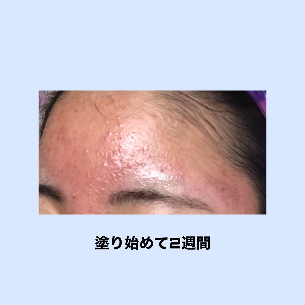 soa on LIPS 「⚠️至急⚠️べピオゲルの副作用に関する相談です!白ニキビが気に..」(2枚目)