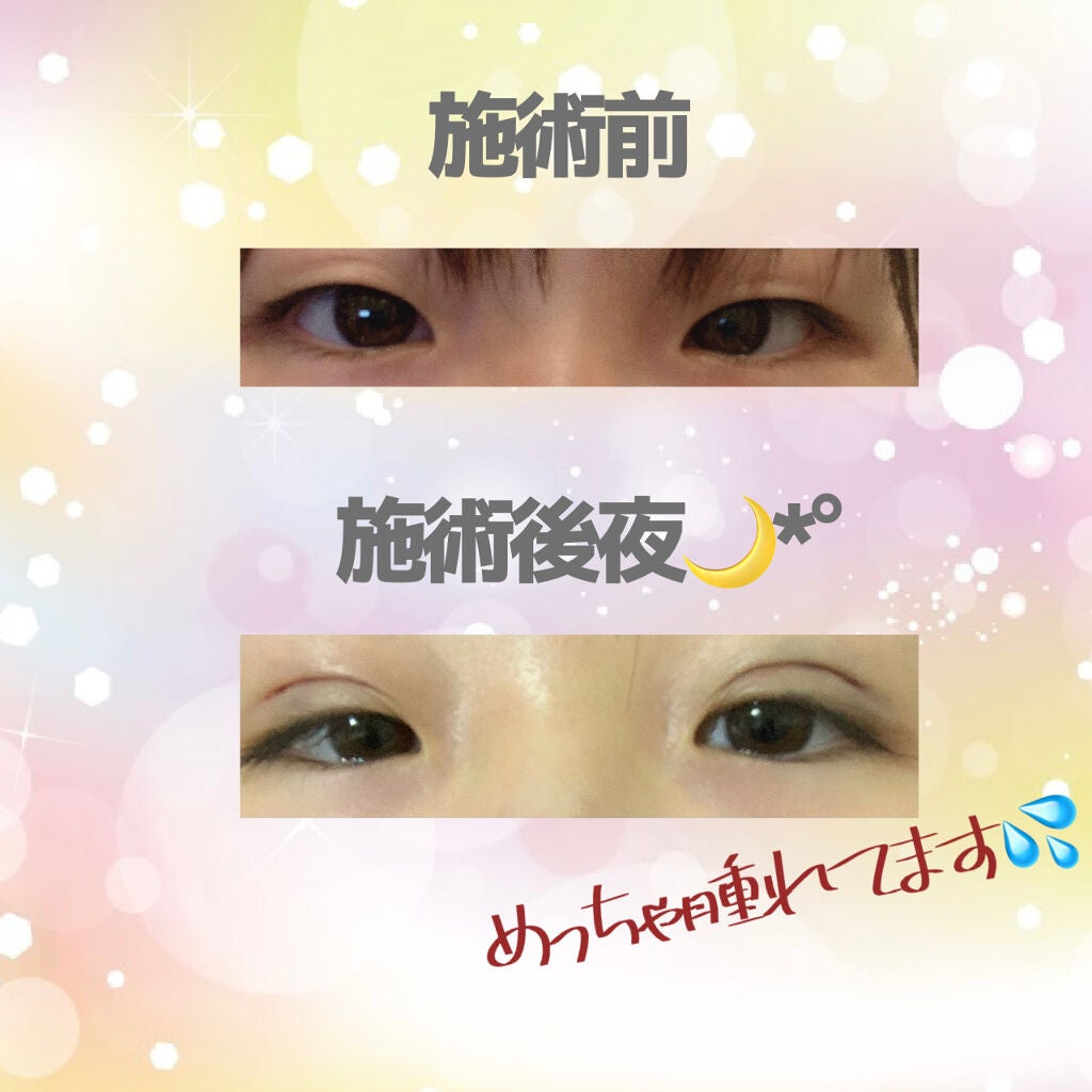 シナティ大好き on LIPS 「【初投稿】やっと中学卒業…!!!良い区切りということで二重埋没..」(2枚目)