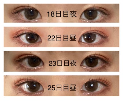 YuMi on LIPS 「埋没の再施術しました。経過まとめです。数ヶ月前に埋没施術しまし..」(6枚目)