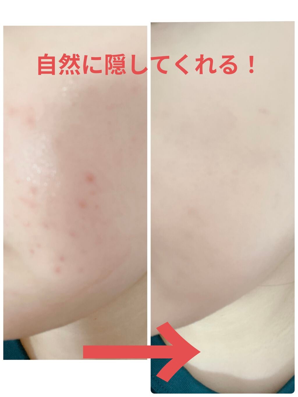 【旧】ディオールスキン フォーエヴァー スキン コレクト コンシーラー/Dior/リキッドコンシーラーを使ったクチコミ(2枚目)