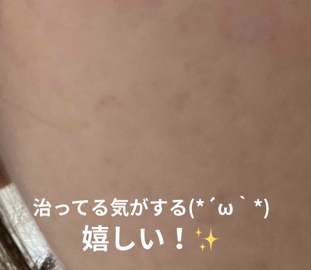 薬用泡のふんわり洗顔/スキンライフ/泡洗顔を使ったクチコミ（3枚目）