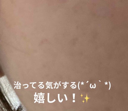 薬用泡のふんわり洗顔/スキンライフ/泡洗顔を使ったクチコミ(3枚目)