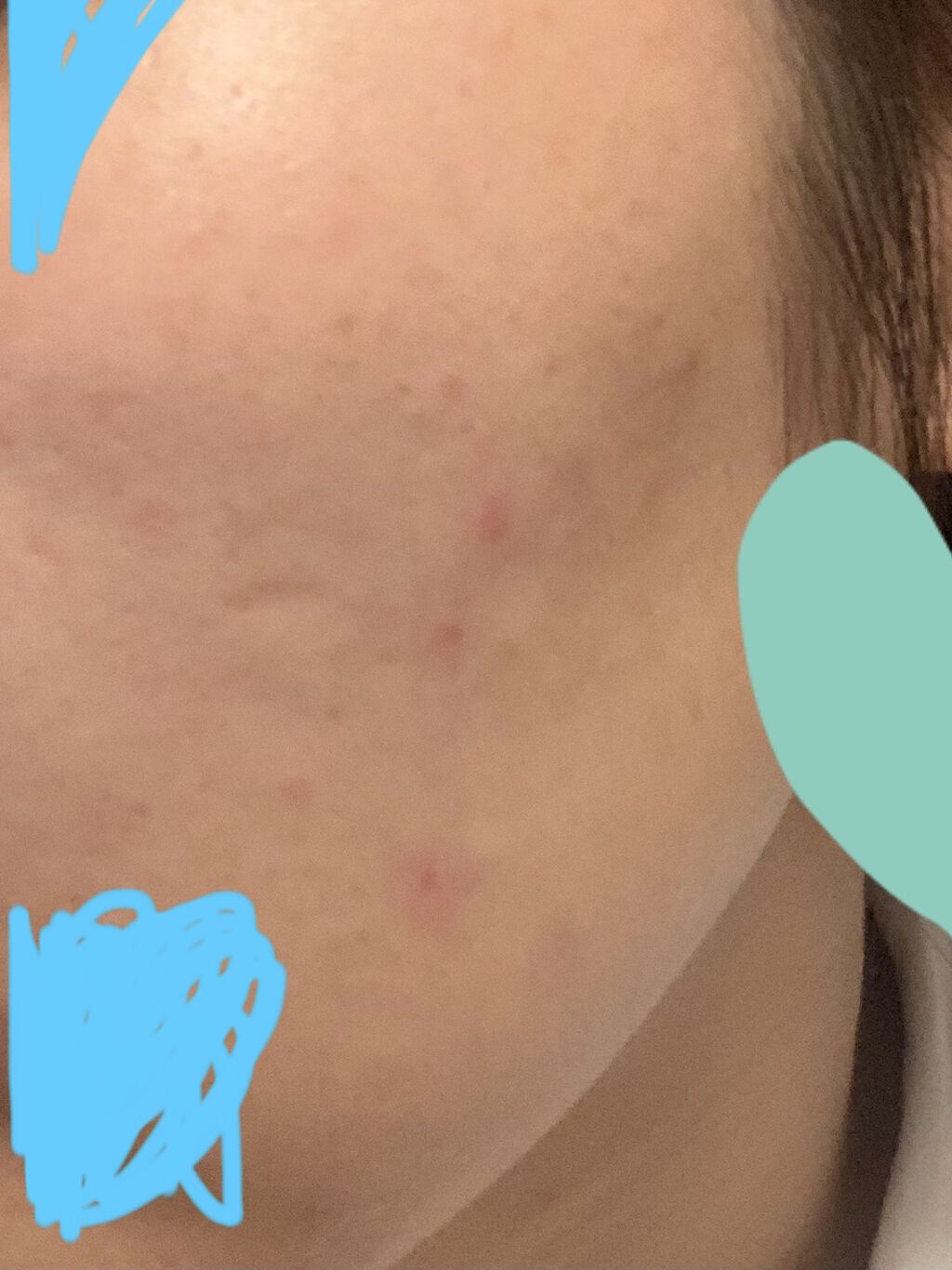 FDR アクネケア ジェル乳液/ファンケル/乳液を使ったクチコミ（3枚目）