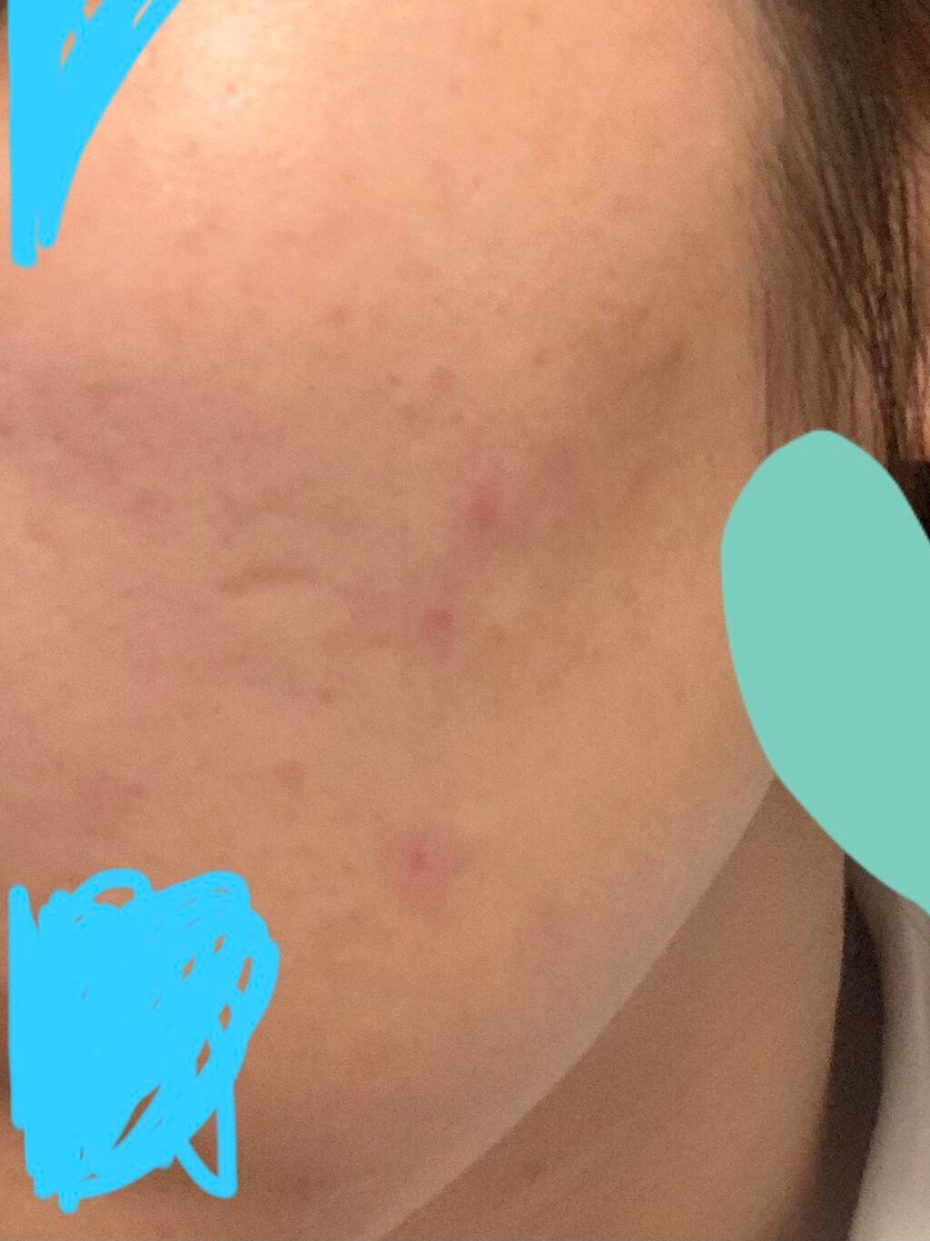 FDR アクネケア 化粧液/ファンケル/化粧水を使ったクチコミ(3枚目)