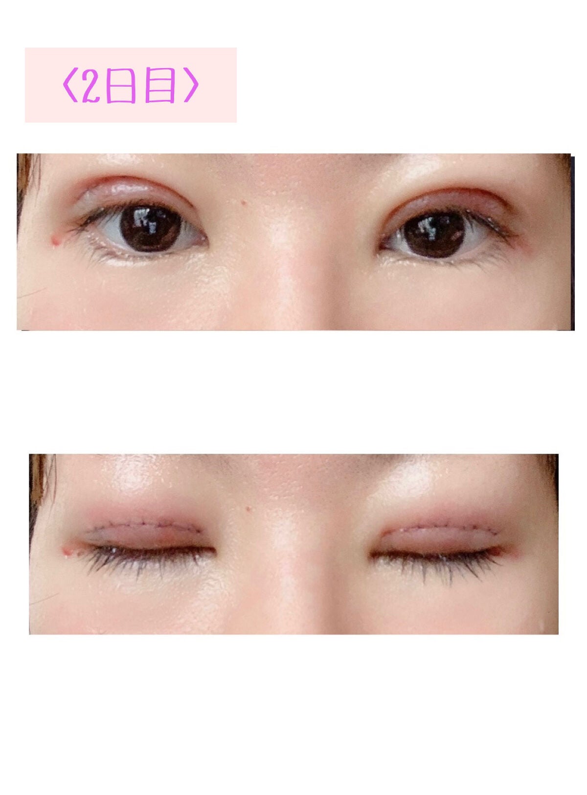 すずな on LIPS 「二重全切開ダウンタイムレポ以前埋没を2度経験して、3ヶ月程で取..」(6枚目)